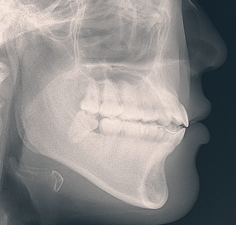Cropped lateral cephalometric radiograph showing the jaws and teeth, tinted in warm tones.